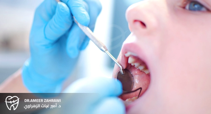 تسوس الأسنان عند الأطفال
