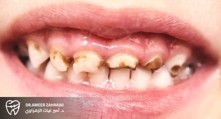  أسباب تسوس الأسنان عند الأطفال
