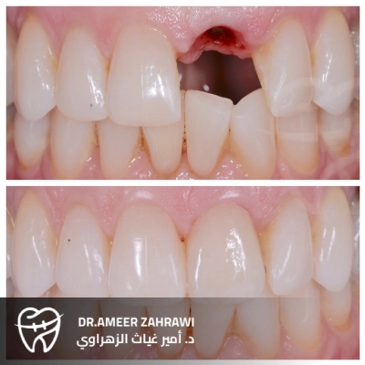 مميزات تركيب الأسنان الأمامية