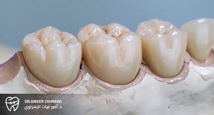 عيوب بورسلين الأسنان