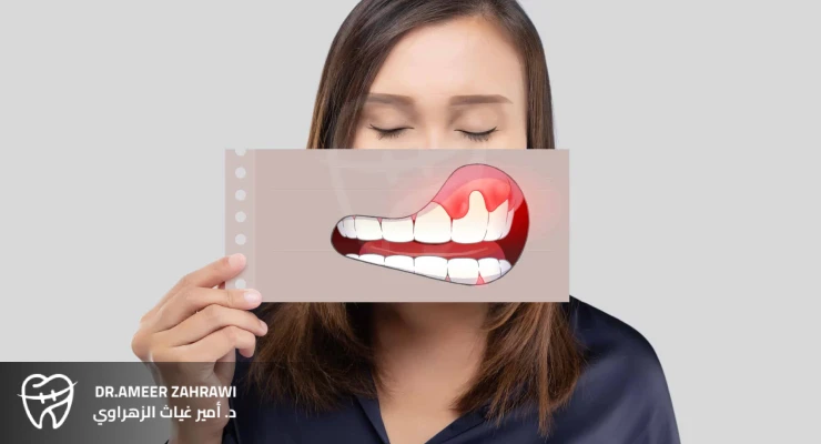 أعراض إصابة اللثة بالأمراض