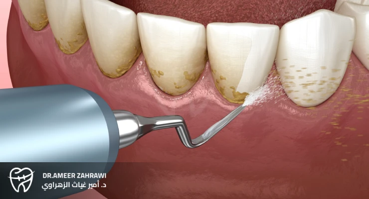علاج التهاب اللثة