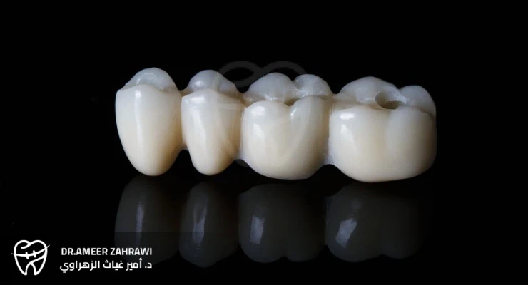 التيجان المؤقتة