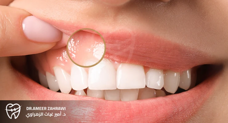 علاج مشكلة بقع الأسنان البيضاء