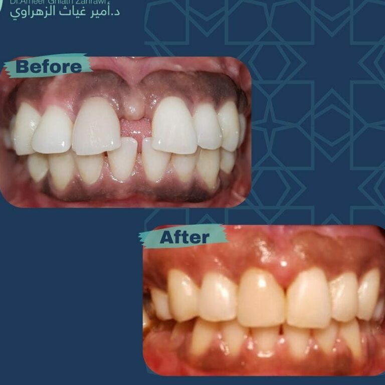 تجربتي مع تقويم الاسنان لدى د. أمير الزهراوي