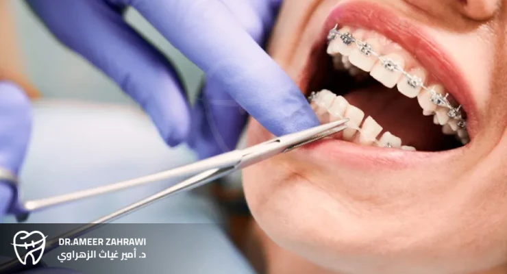 مراحل تركيب تقويم الأسنان