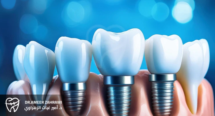 أحدث التقنيات لدى الدكتورة عبير زنداقي في مجال تركيبات الأسنان