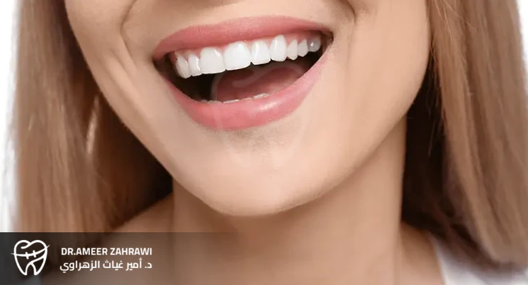 ابتسامة هوليوود