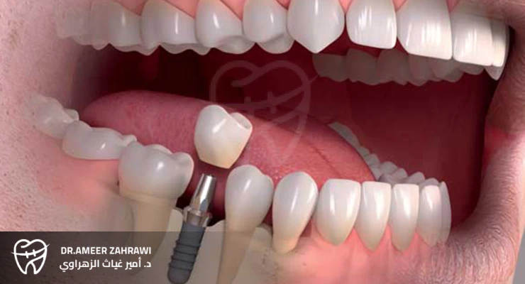 زراعة الأسنان الفورية