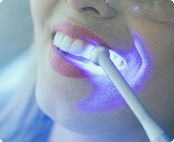 Teeth Whitening in Jeddah