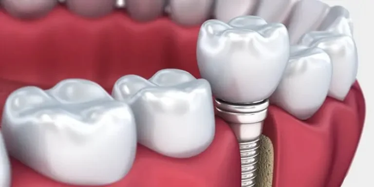 خطوات زراعة الأسنان بالليزر بالتفصيل  