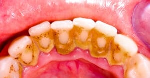 Cleaning teeth from tartar: The complete guide to removing tartar and protecting gums