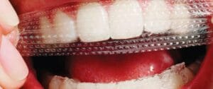Teeth whitening strips: The complete guide