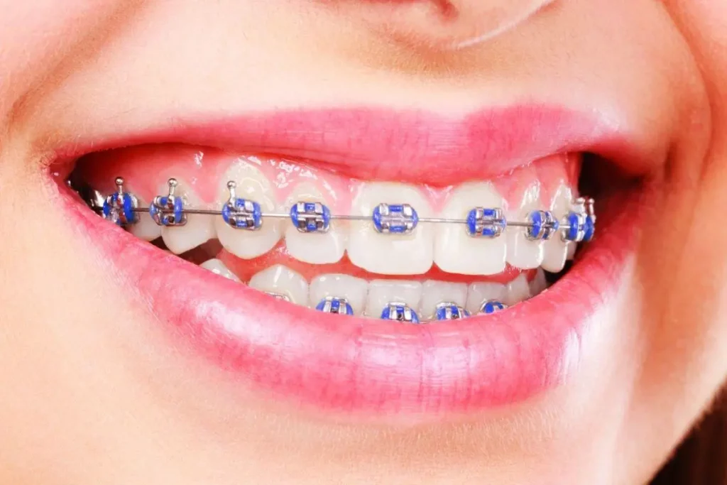 أسباب اعوجاج الأسنان