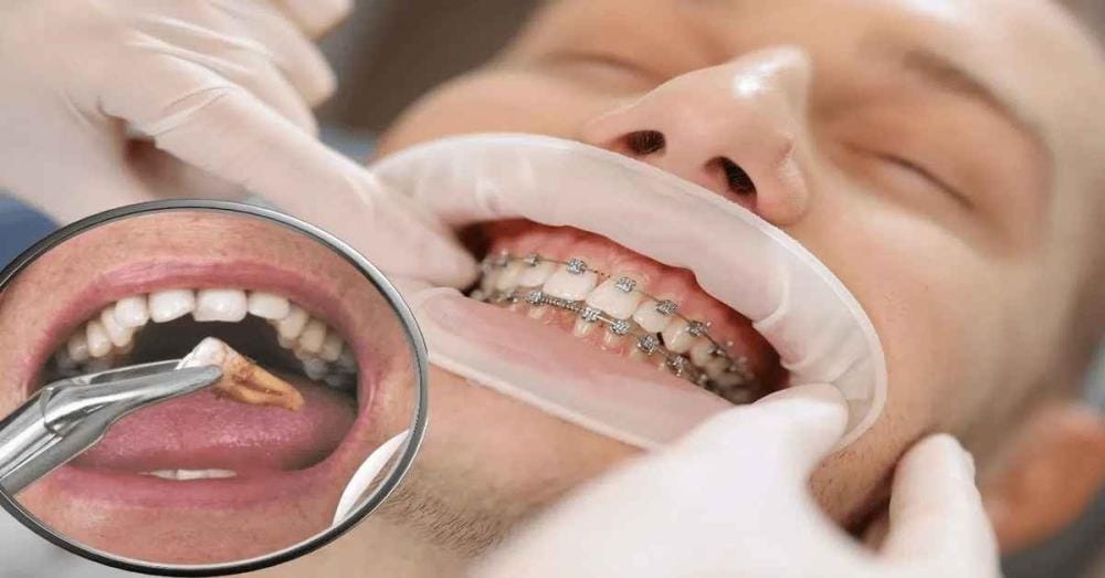 التقويم أم خلع الأسنان