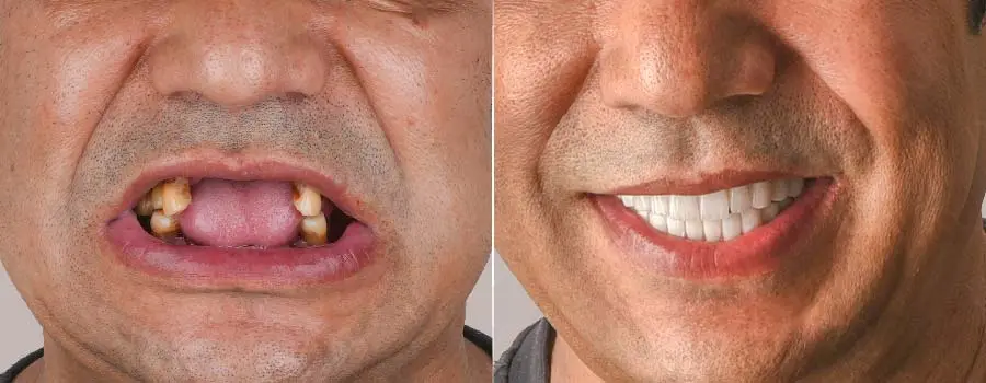 إعادة بناء الأسنان