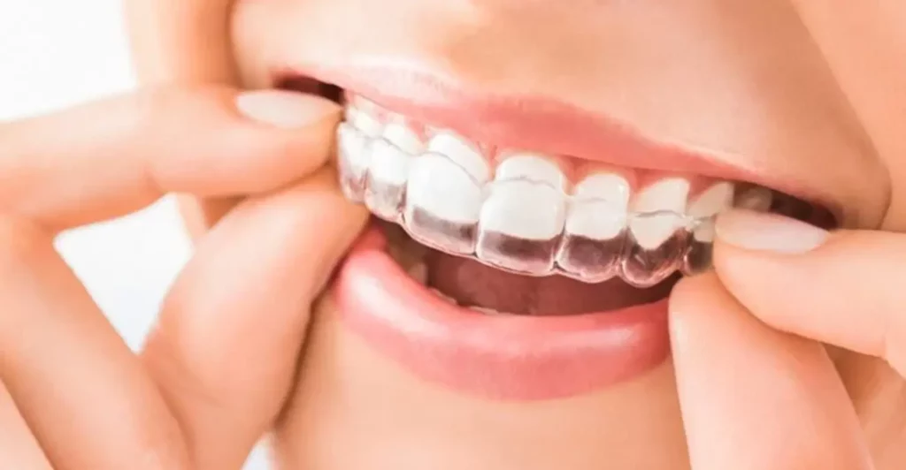 ضيق الفك وعدم توفر مساحة كافية للأسنان