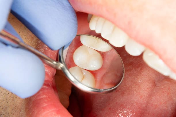 الحشوات التجميلية (الكومبوزيت)
