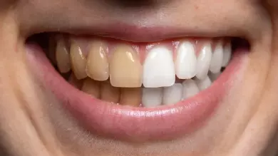 كيف يمكن الوقاية من تصبغات الأسنان أثناء التقويم؟