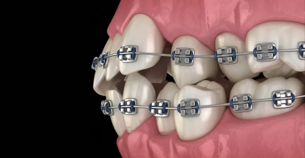 ما العلامات التي تدل على بداية عودة الأسنان للاعوجاج؟