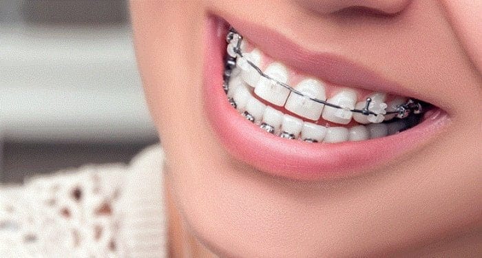 مزايا المثبت الدائم مقارنة بالمثبت المتحرك