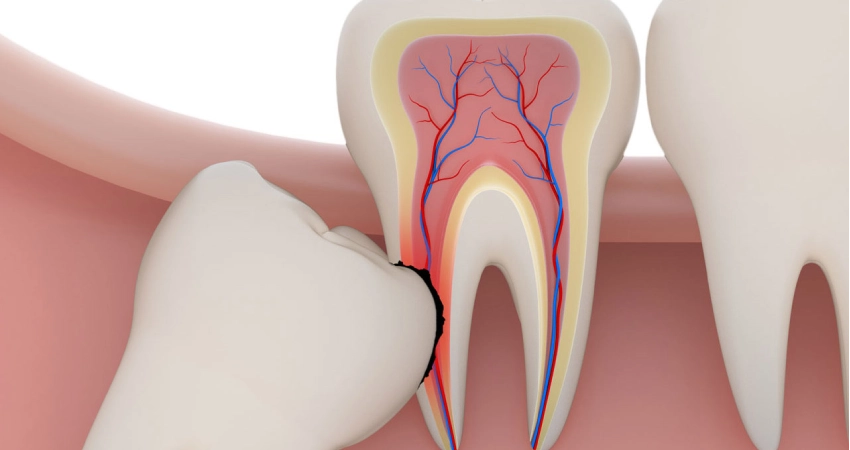when should a wisdom tooth be removed