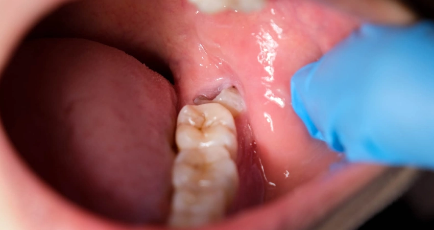 When Is Wisdom Tooth Extraction Necessary?